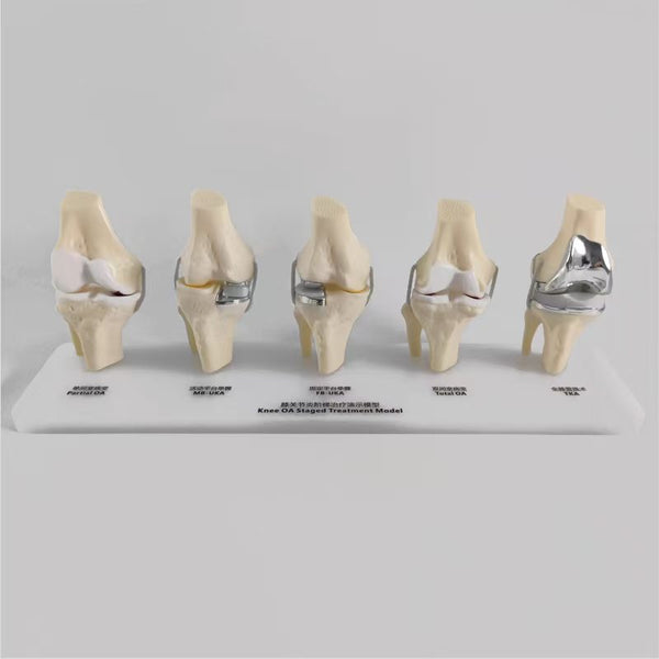 Demonstration Model of Stepwise Treatment for Knee Arthritis